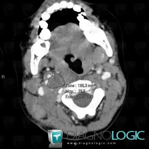 Neuroblastoma, Deep facial spaces, CT