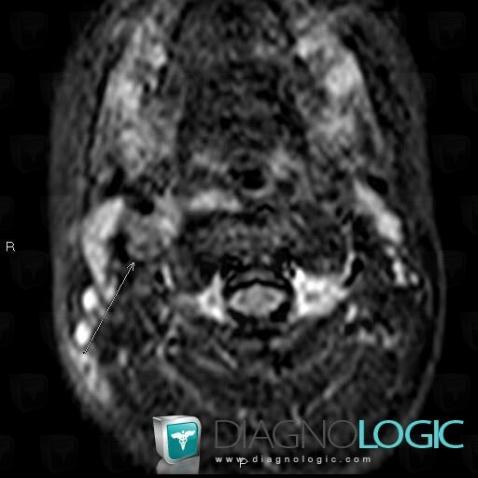 Neuroblastoma, Deep facial spaces, MRI