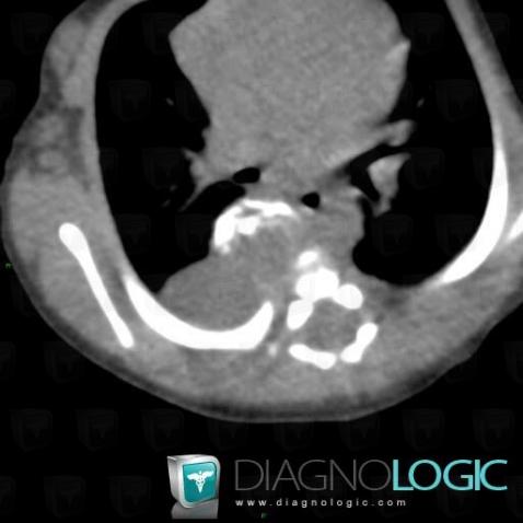 Neuroblastoma, Mediastinum, CT