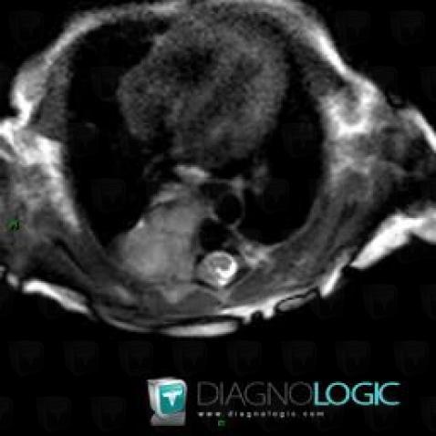 Neuroblastoma, Mediastinum, Paraspinal, MRI