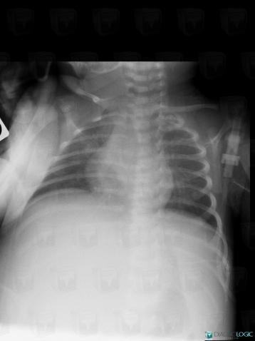 Neuroblastoma, Mediastinum, X rays