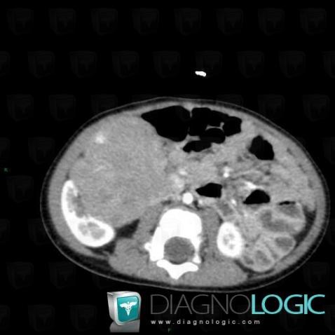 Neuroblastoma, Retroperitoneum, Adrenal glands, CT