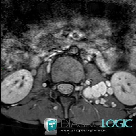 Neurofibroma, Abdominal wall, Retroperitoneum, MRI