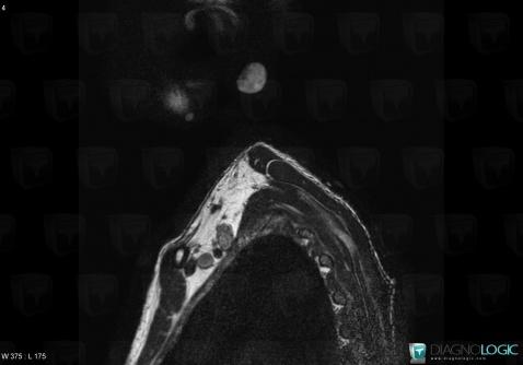 Neurofibroma, Chest wall, MRI