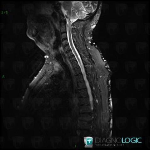 Neurofibroma, Chest wall, MRI