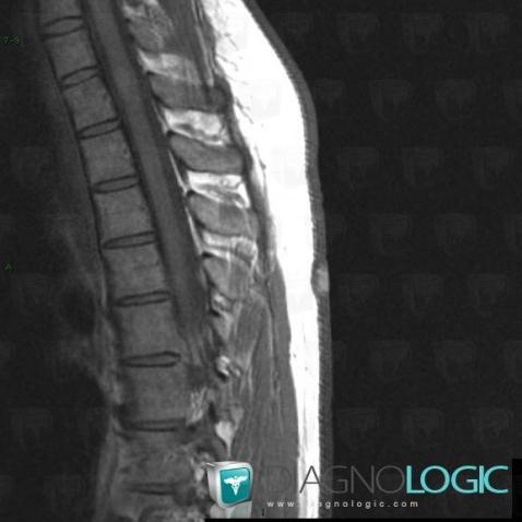 Neurofibroma, Chest wall, MRI