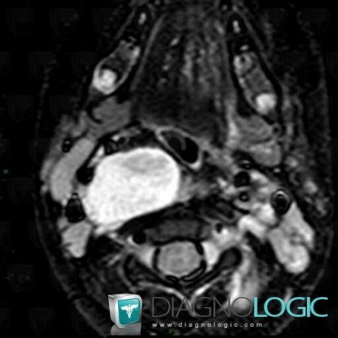 Neurofibroma, Deep facial spaces, MRI