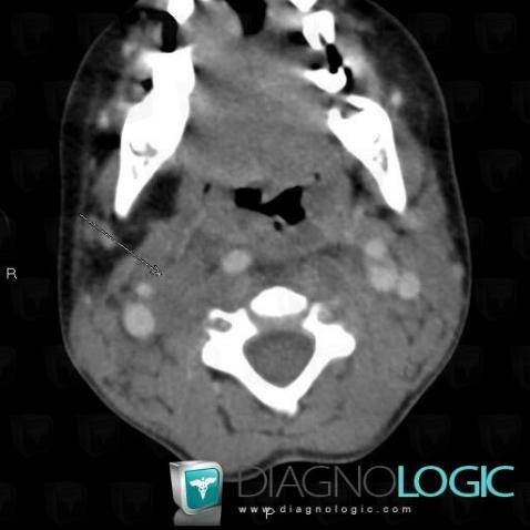 Neurofibroma, Deep facial spaces, Paraspinal, CT