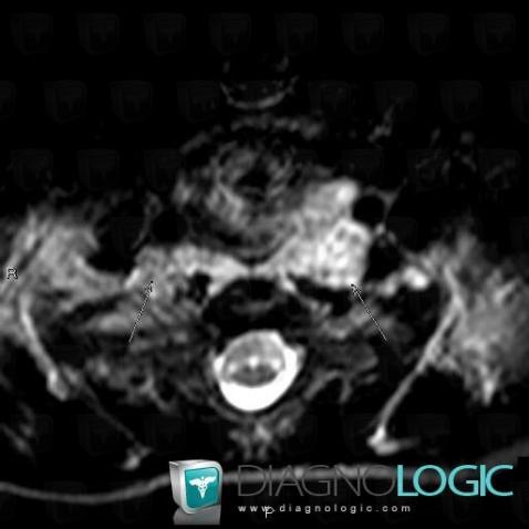 Neurofibroma, Deep facial spaces, Paraspinal, MRI