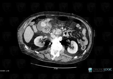 Neurofibroma, Duodenum, CT