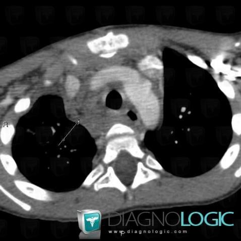 Neurofibroma, Mediastinum, CT