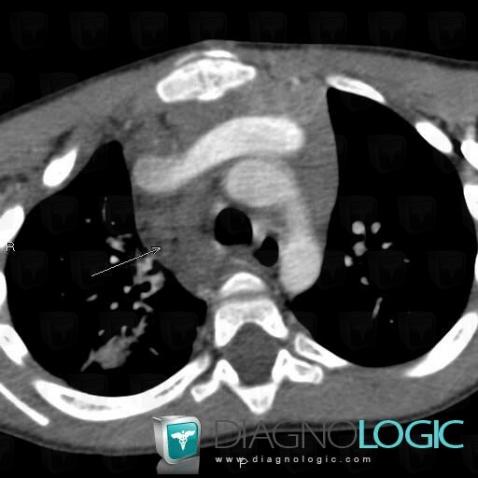 Neurofibroma, Mediastinum, CT