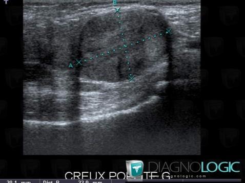 Neurofibroma, Other soft tissues/nerves - Knee, US