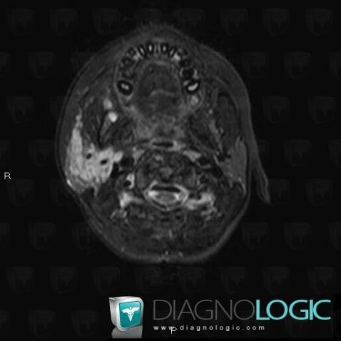 Neurofibroma, Parotid and other salivary glands, MRI
