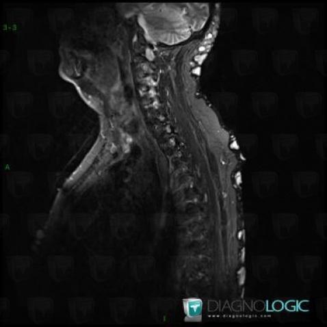 Neurofibroma, Soft tissues - Head and neck, Paraspinal, MRI