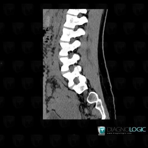 Neurofibroma, Spinal canal / Cord, CT