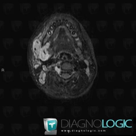 Neurofibroma, Spinal canal / Cord, MRI