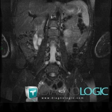 Neurofibroma, Spinal canal / Cord, MRI