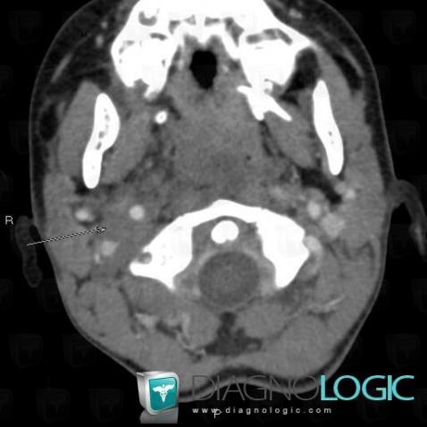 Neurofibromatose, Espaces profonds de-face, Scanner