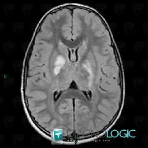 Neurofibromatose, Noyaux gris centraux et capsule, IRM