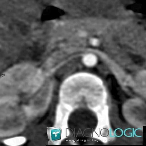 Neurofibromatosis, Abdominal aorta branches, CT