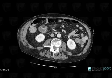 Neurofibromatosis, Abdominal wall, CT