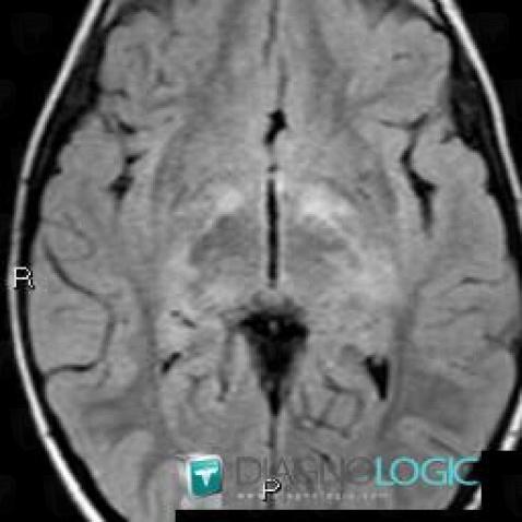 Neurofibromatosis, Basal ganglia and capsule, MRI