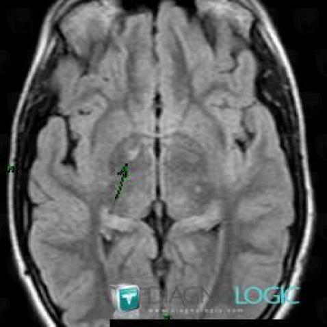 Neurofibromatosis, Basal ganglia and capsule, MRI