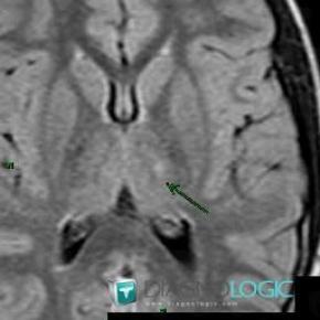 Neurofibromatosis, Basal ganglia and capsule, MRI