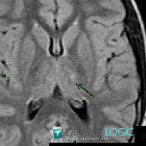 Neurofibromatosis, Basal ganglia and capsule, MRI