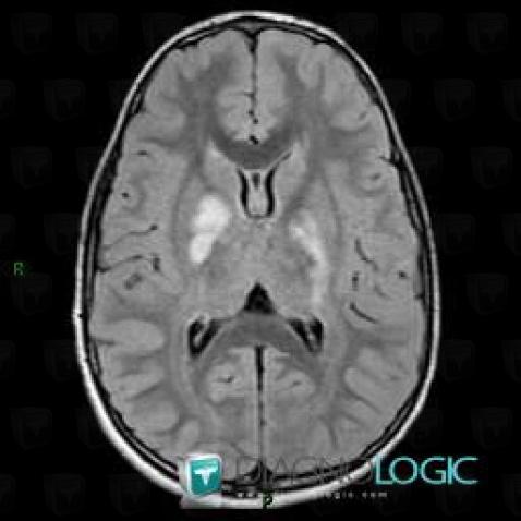 Neurofibromatosis, Basal ganglia and capsule, MRI