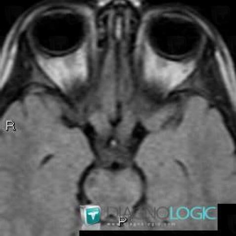 Neurofibromatosis, Eye, MRI