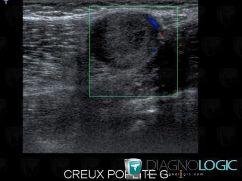 Neurofibromatosis, Other soft tissues/nerves - Knee, US