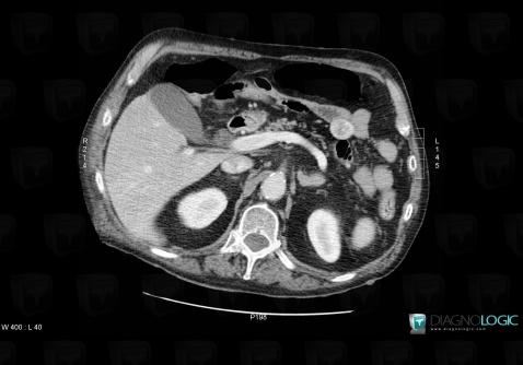 Neurofibromatosis, Small bowel, CT