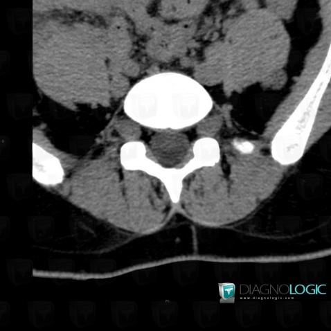 Neurofibromatosis, Spinal canal / Cord, CT