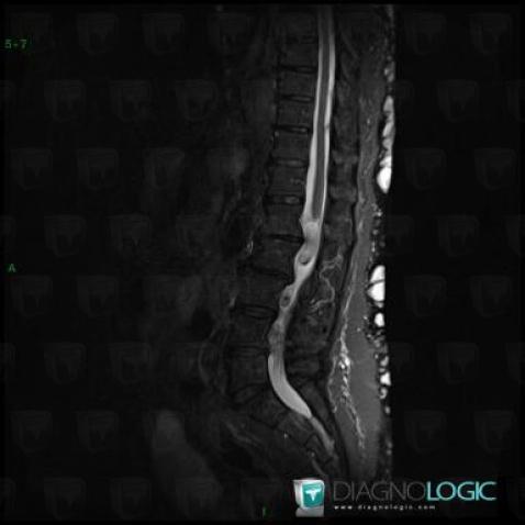 Neurofibromatosis, Spinal canal / Cord, MRI