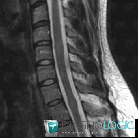 Neurofibromatosis, Spinal canal / Cord, MRI