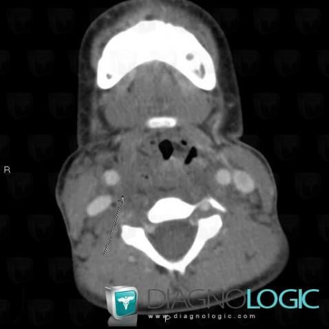 Neurofibrome , Espaces profonds-cou, Scanner