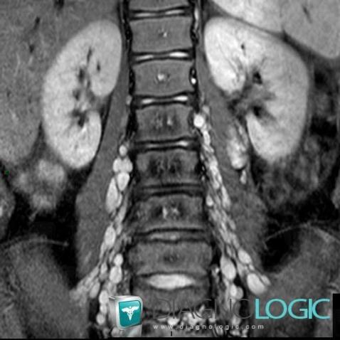 Neurofibrome , Paravertébral, IRM