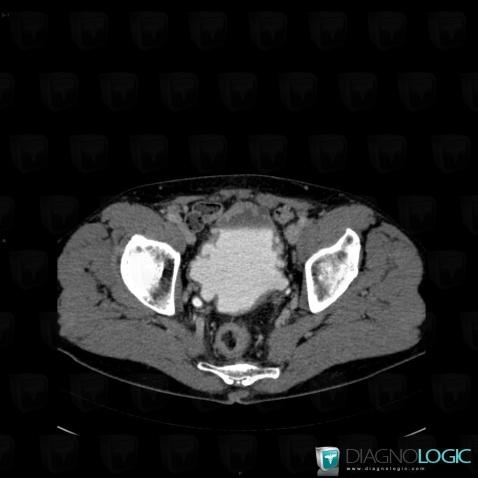 Neurogenic bladder, Urinary bladder, CT