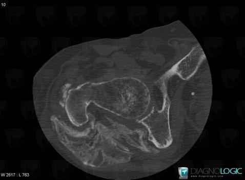 Neurogenic Para-Osteo-Arthropathy, Coxo femoral joint, Other soft tissues/nerves - Pelvis, CT