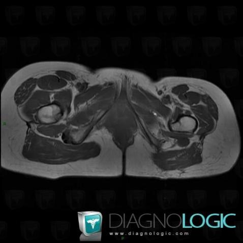 Neuroma, Other soft tissues/nerves - Pelvis, MRI