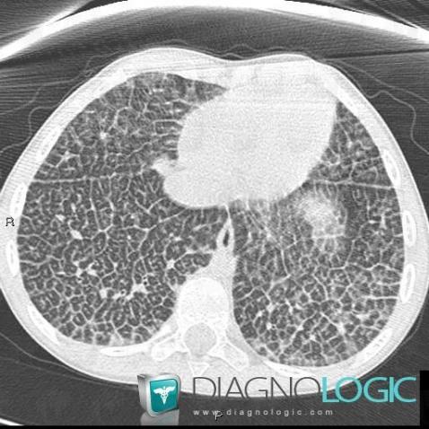 Niemann-Pick disease, Pulmonary parenchyma, CT