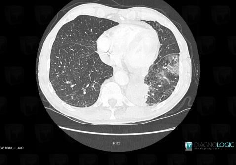 Nocardiosis, Pulmonary parenchyma, CT