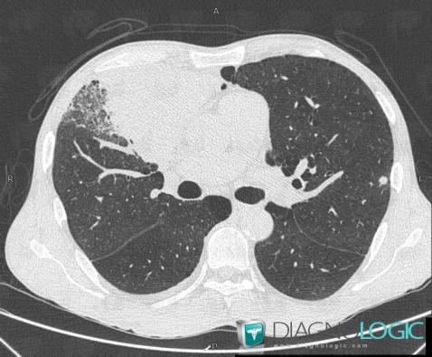 Nocardiosis, Pulmonary parenchyma, CT