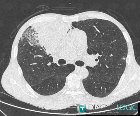 Nocardiosis, Pulmonary parenchyma, CT