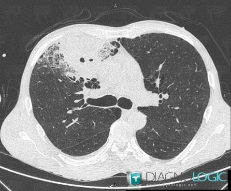 Nocardiosis, Pulmonary parenchyma, CT