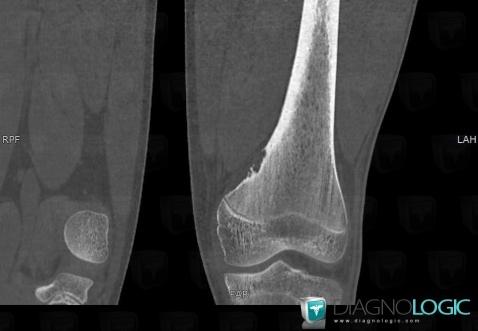 Nonossifying fibroma, Femur - Distal part, CT