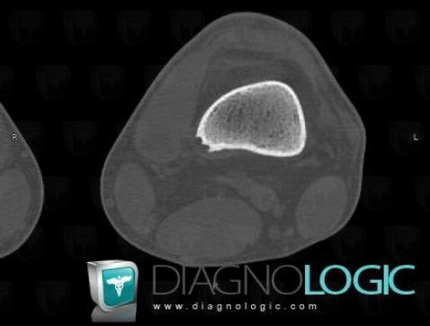 Nonossifying fibroma, Femur - Distal part, CT