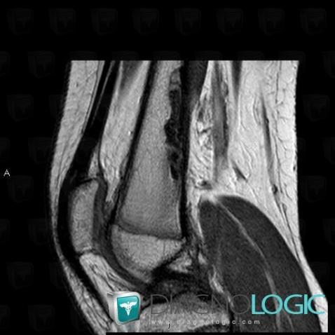 Nonossifying fibroma, Femur - Distal part, MRI